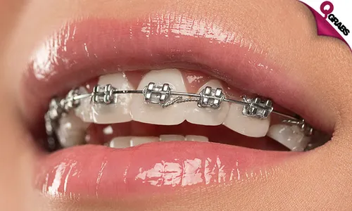 Metal Dental Braces!